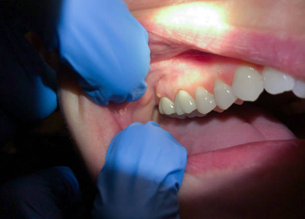 Best Chipped Tooth Repair Near Me  in Lake Hopatcong, NJ